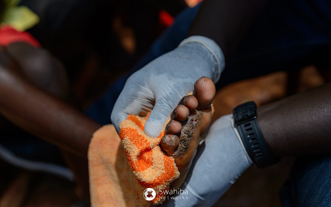 🌍 Join the Battle Against Jiggers: Protect Vulnerable Feet 🦶👟